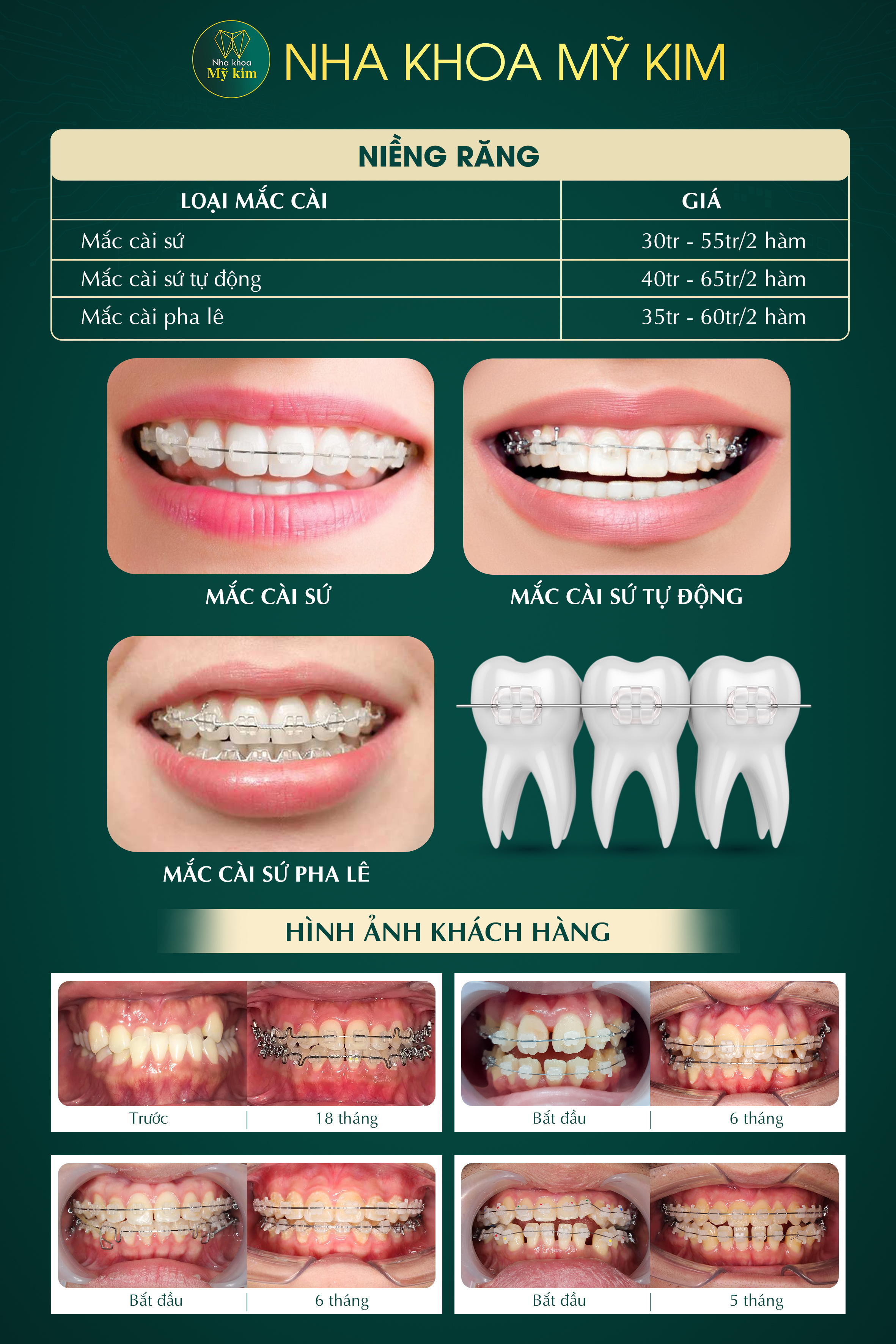 Bảng giá dịch vụ niềng răng thẩm mỹ tại nha khoa mỹ kim 2