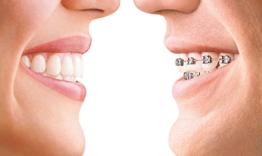 khám bác sĩ kịp thời để biết về dịch vụ niềng răng