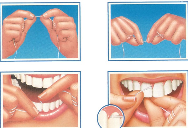 Dùng chỉ nha khoa khi niềng răng