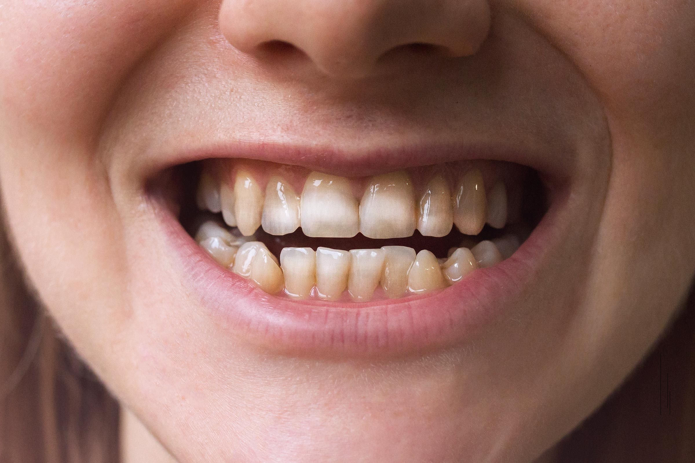 Trình trạng cũng ảnh hưởng đến thời gian niềng răng