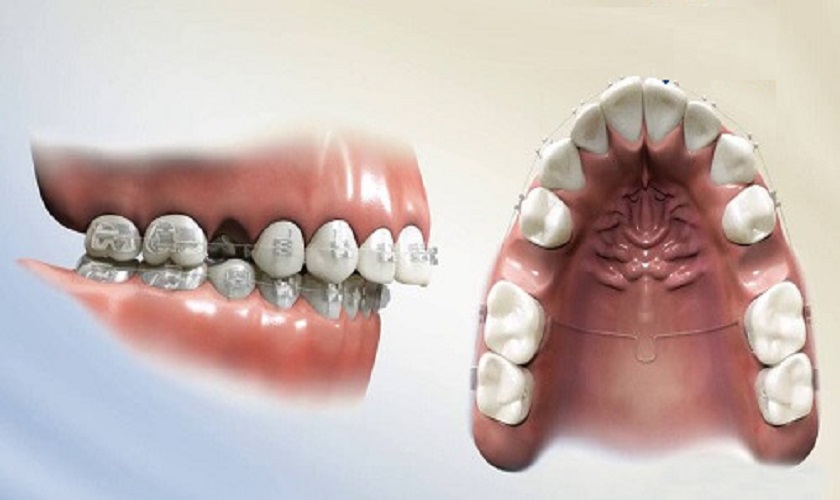 Nhổ răng chính là để tạo ra khoảng trống trên cung hàm