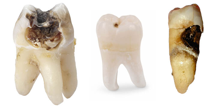 Bị sâu răng có thể ảnh hưởng đến sức khỏe